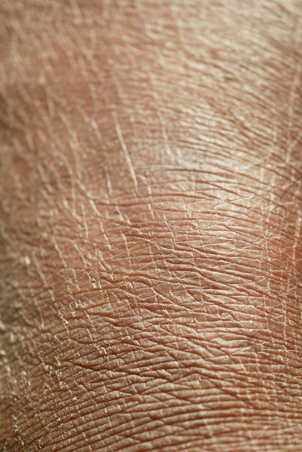 Peau sèche : quel traitement adopté ?